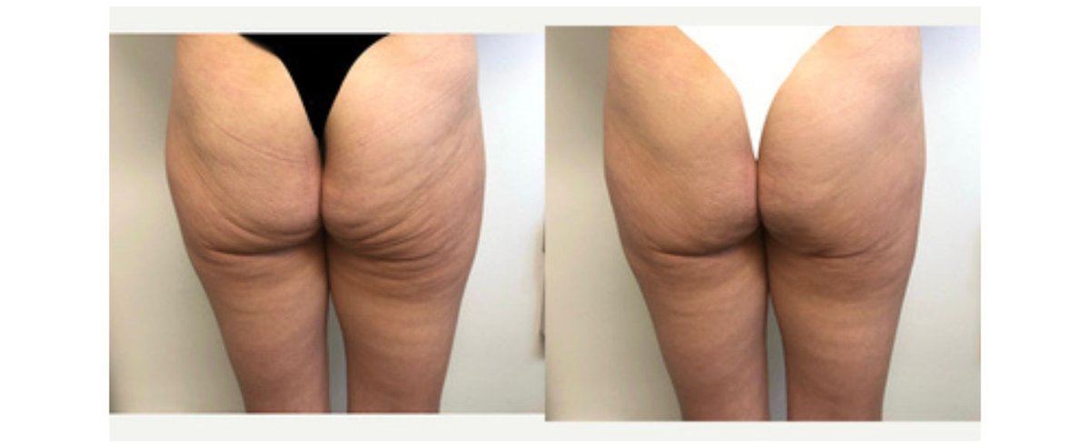 Avant après cellulite cuisses — centre minceur Pierrefitte-sur-Seine