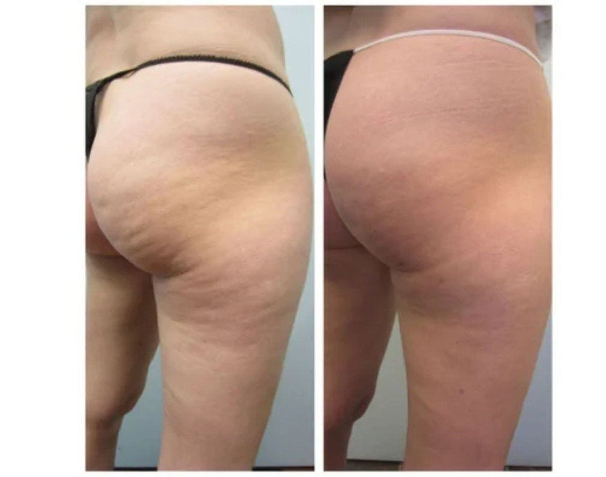 Avant après cellulite fessiers — centre minceur Pierrefitte-sur-Seine