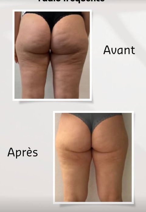 Avant après radiofréquence cellulite