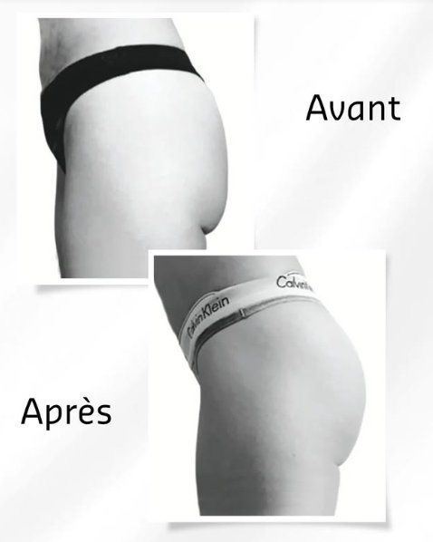 Avant après Supra Sculpt fesses cuisses