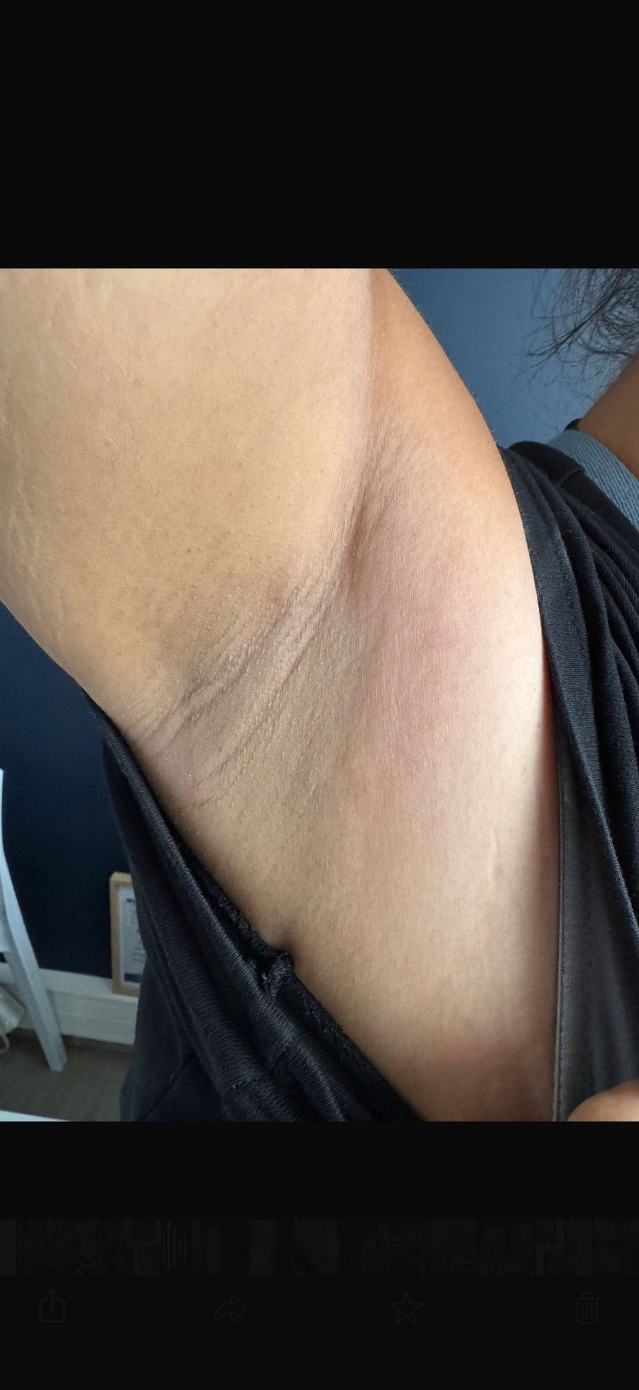 Résultat épilation laser Laser Ligne Groslay