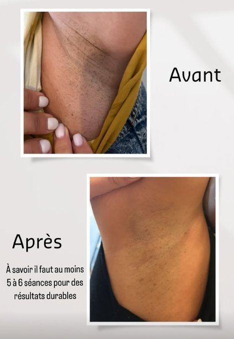Avant après épilation laser jambe 6 séances
