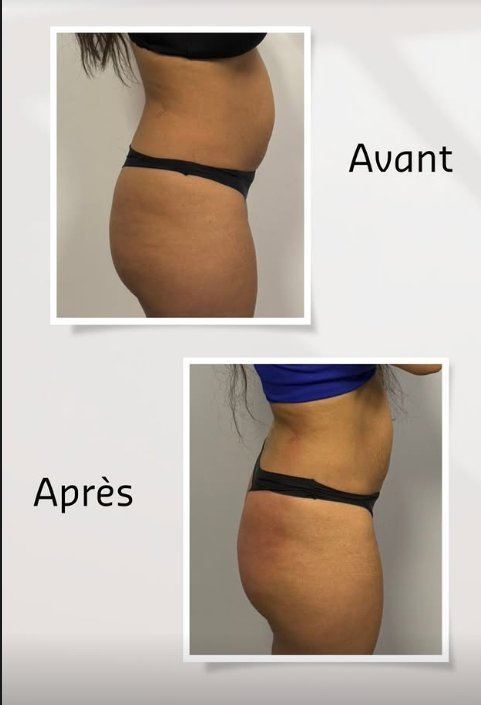Résultat minceur silhouette — centre minceur Pierrefitte-sur-Seine