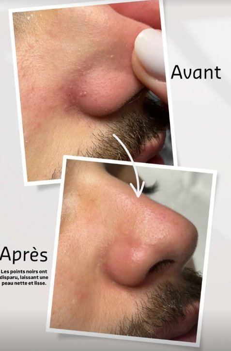 Avant après points noirs