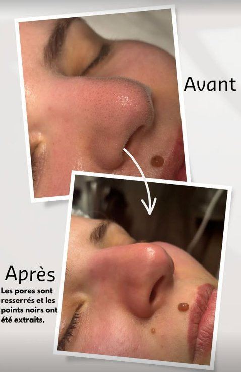 Avant après pores resserrés