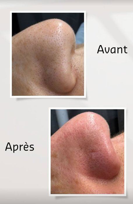 Avant après points noirs nez