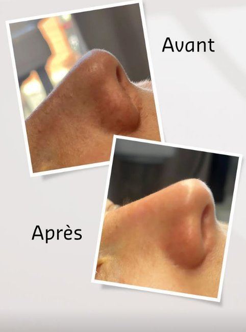 Avant après pores nez