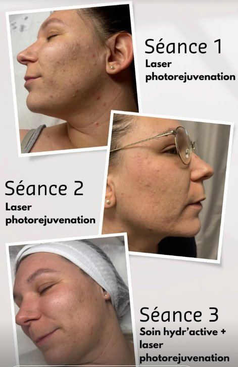 3 séances laser photorajeunissement