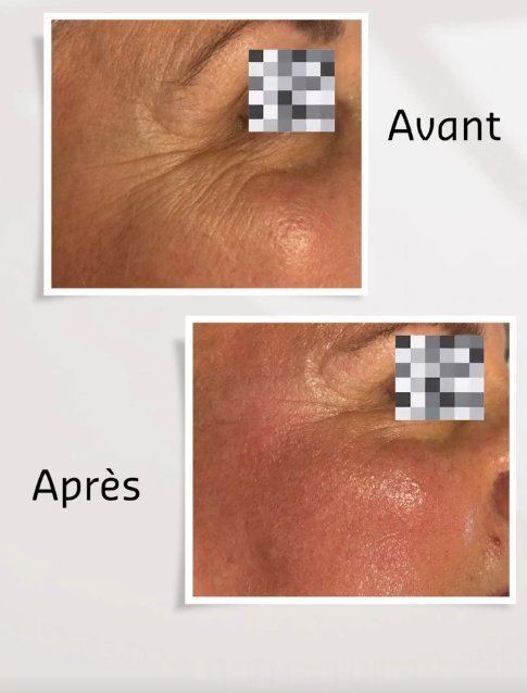 Avant après rides contour yeux