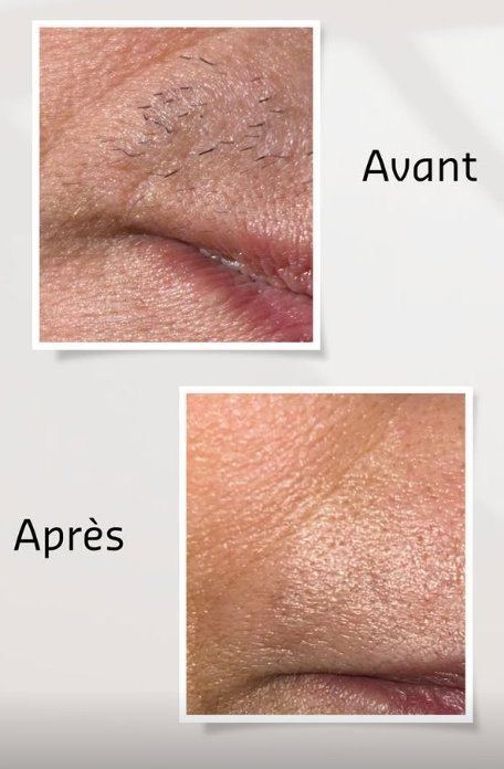 Avant après thermolyse lèvre visage