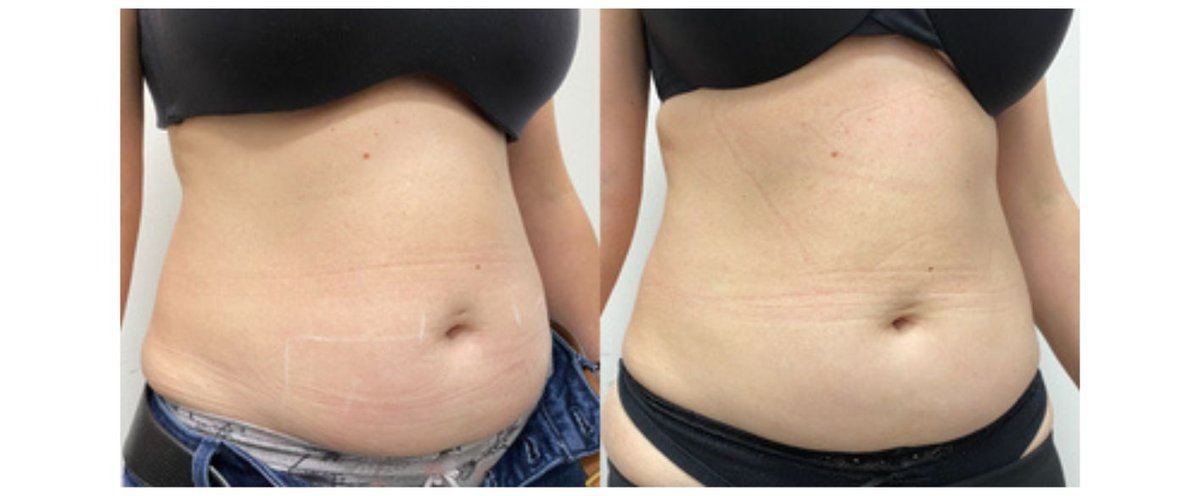 Avant après cryolipolyse ventre