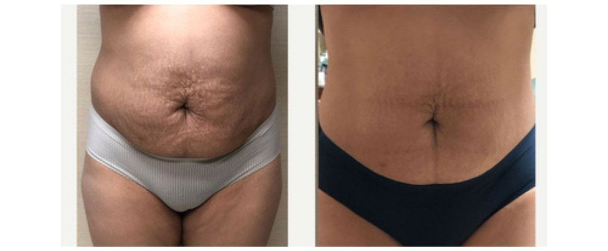 Avant après cryolipolyse ventre résultat