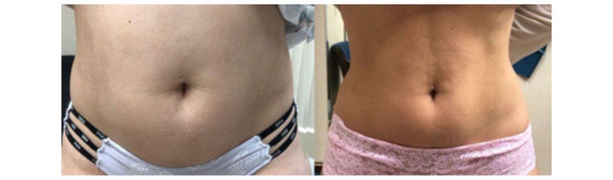 Avant après ventre plat cryolipolyse