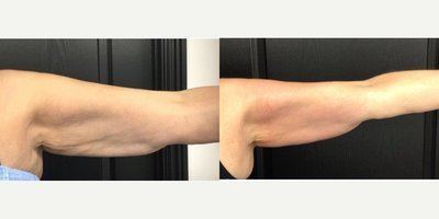 Avant après cryolipolyse bras femme