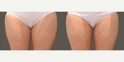 Avant après cryolipolyse cuisses intérieures