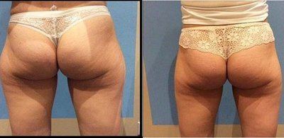 Avant après cryolipolyse fesses cuisses