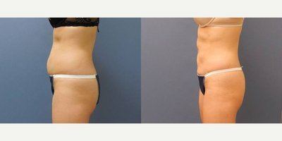 Avant après cryolipolyse hanches