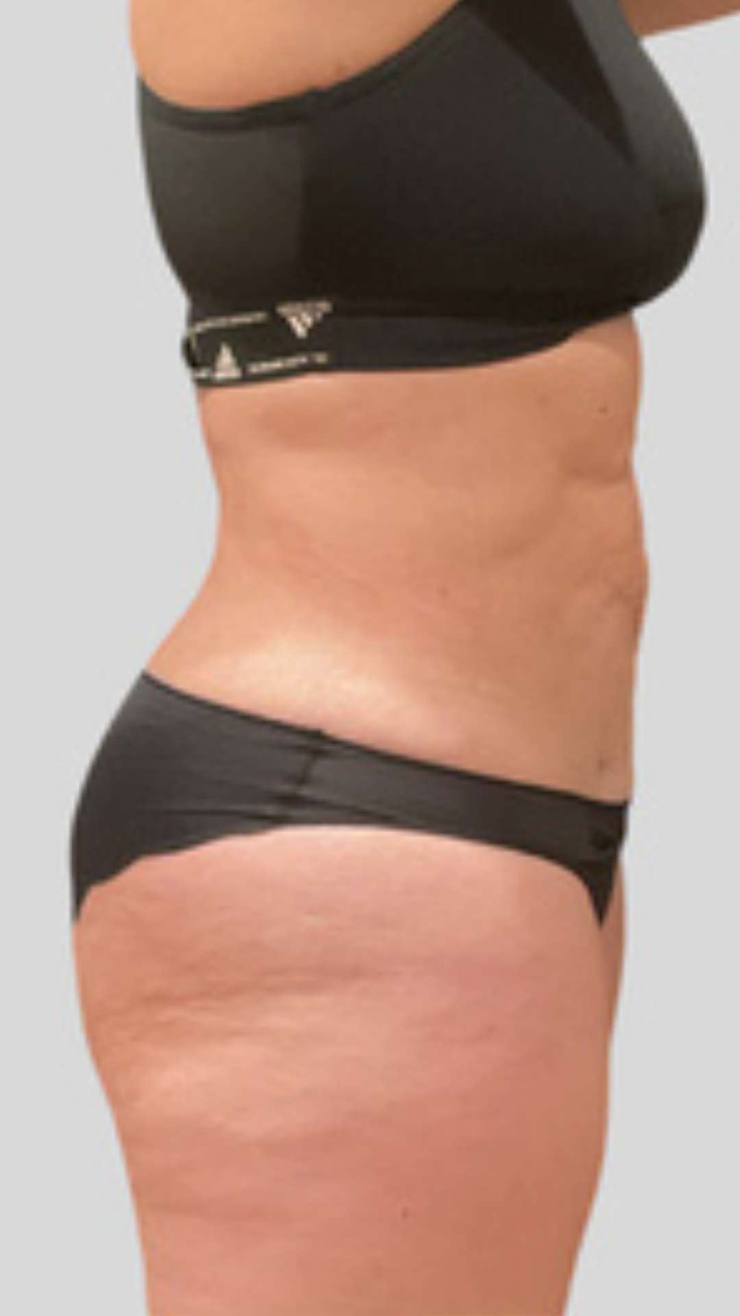 Avant cryolipolyse silhouette ventre — Laser Ligne Groslay