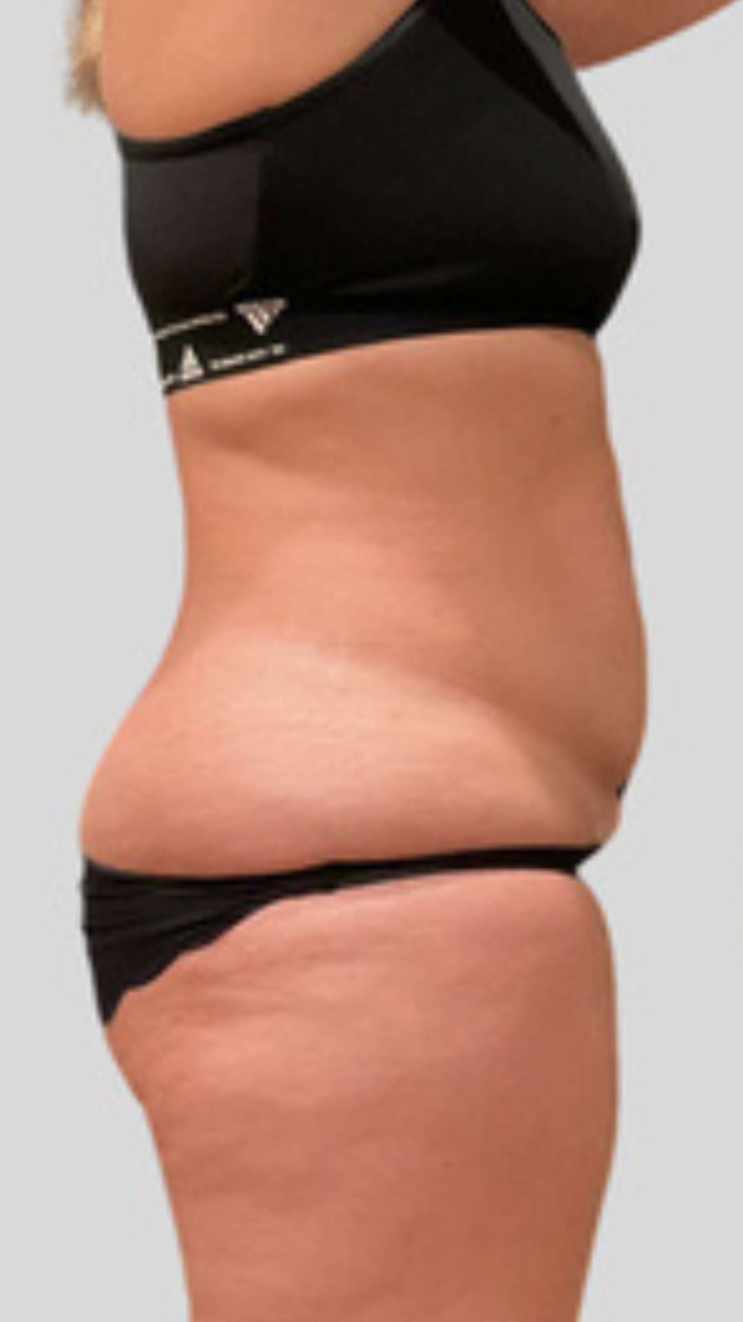 Après cryolipolyse silhouette ventre — Laser Ligne Groslay