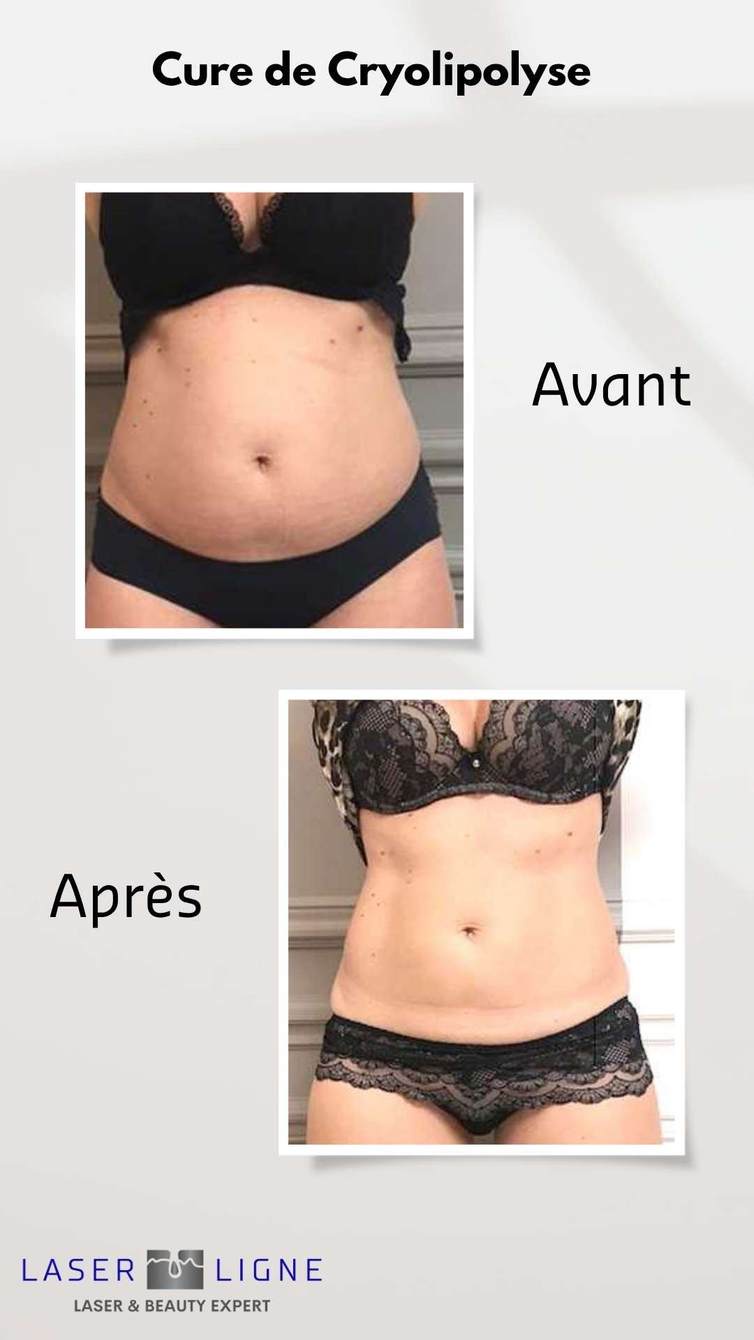 Avant après cryolipolyse ventre silhouette Laser Ligne Groslay