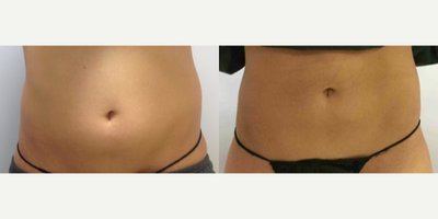 Avant après cryolipolyse ventre femme