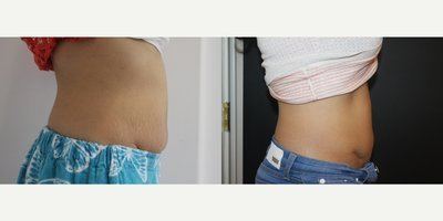 Avant après cryolipolyse ventre flanc