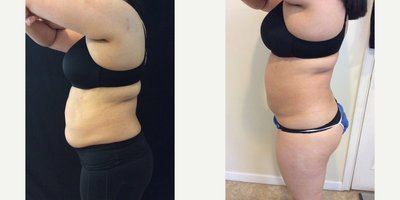 Avant après cryolipolyse flancs profil