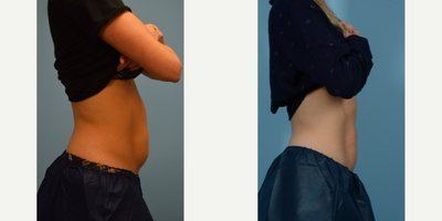 Avant après cryolipolyse ventre profil