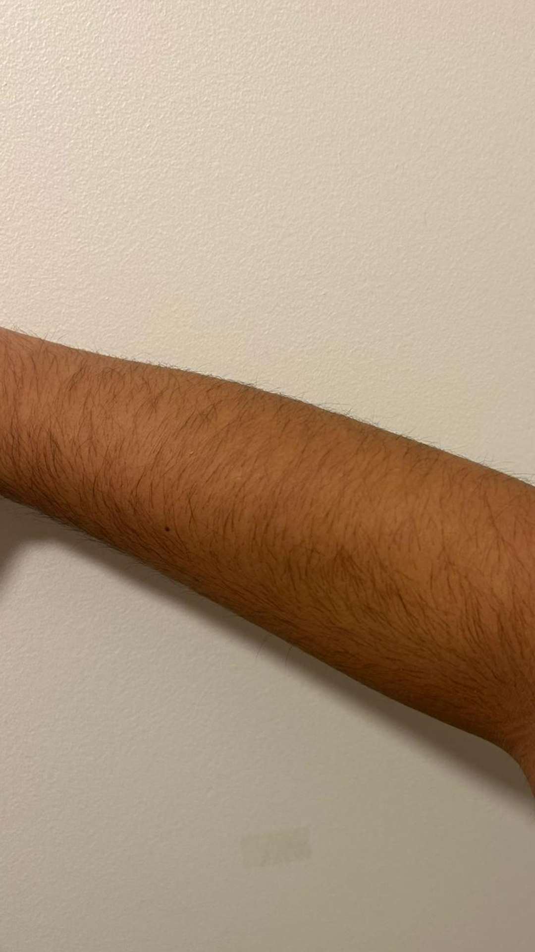 Après épilation laser bras lisse