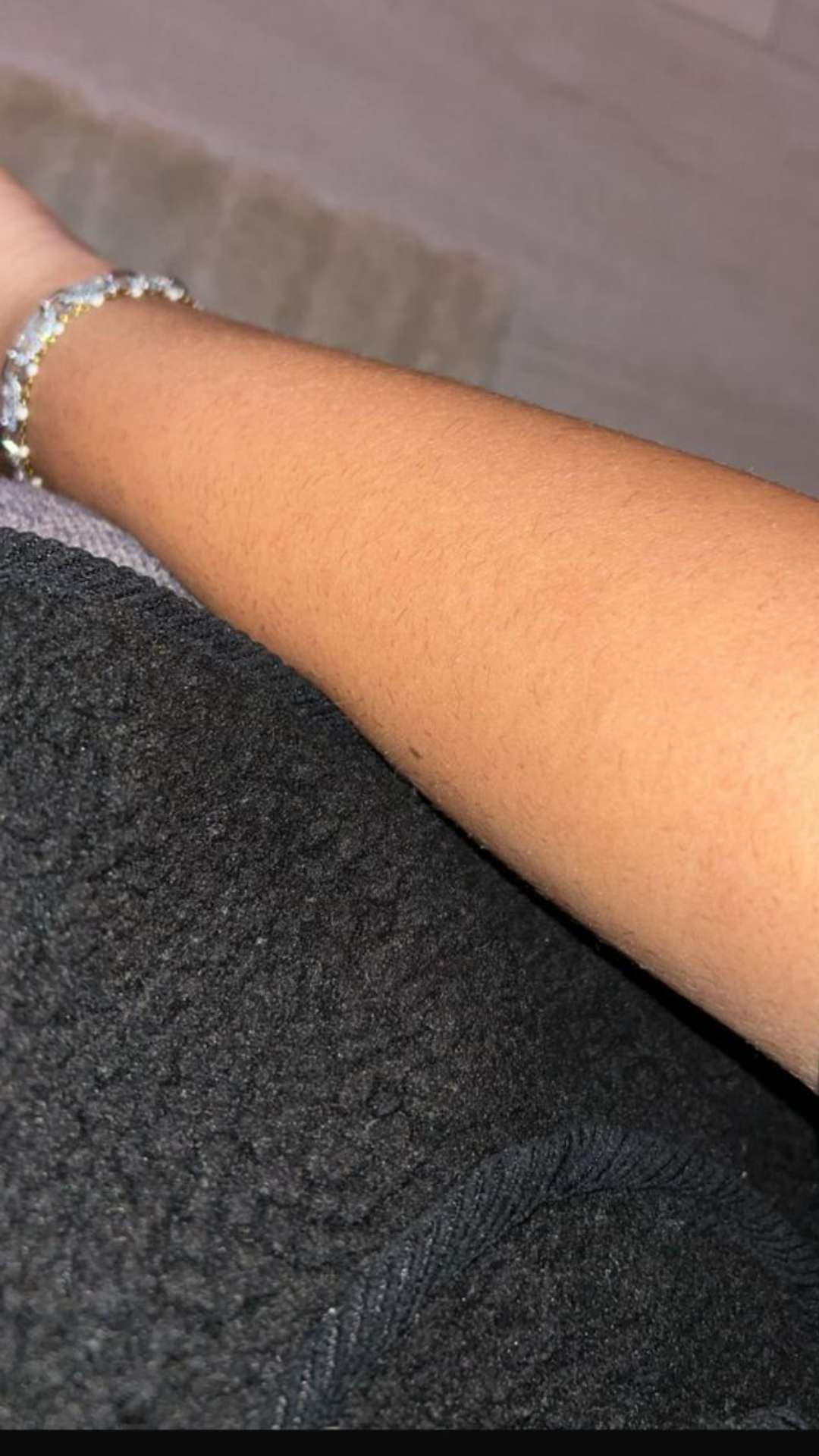 Avant épilation laser bras poilu