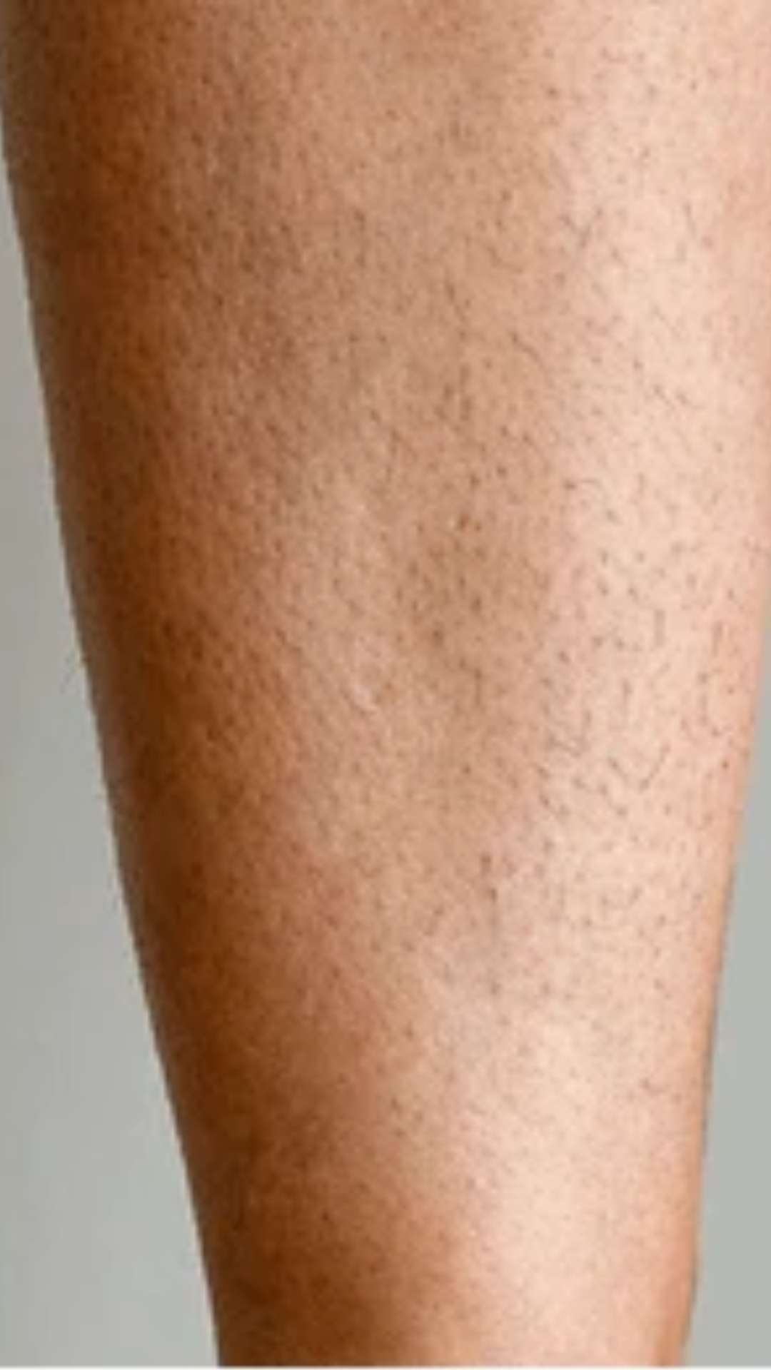 Après épilation laser bras lisse