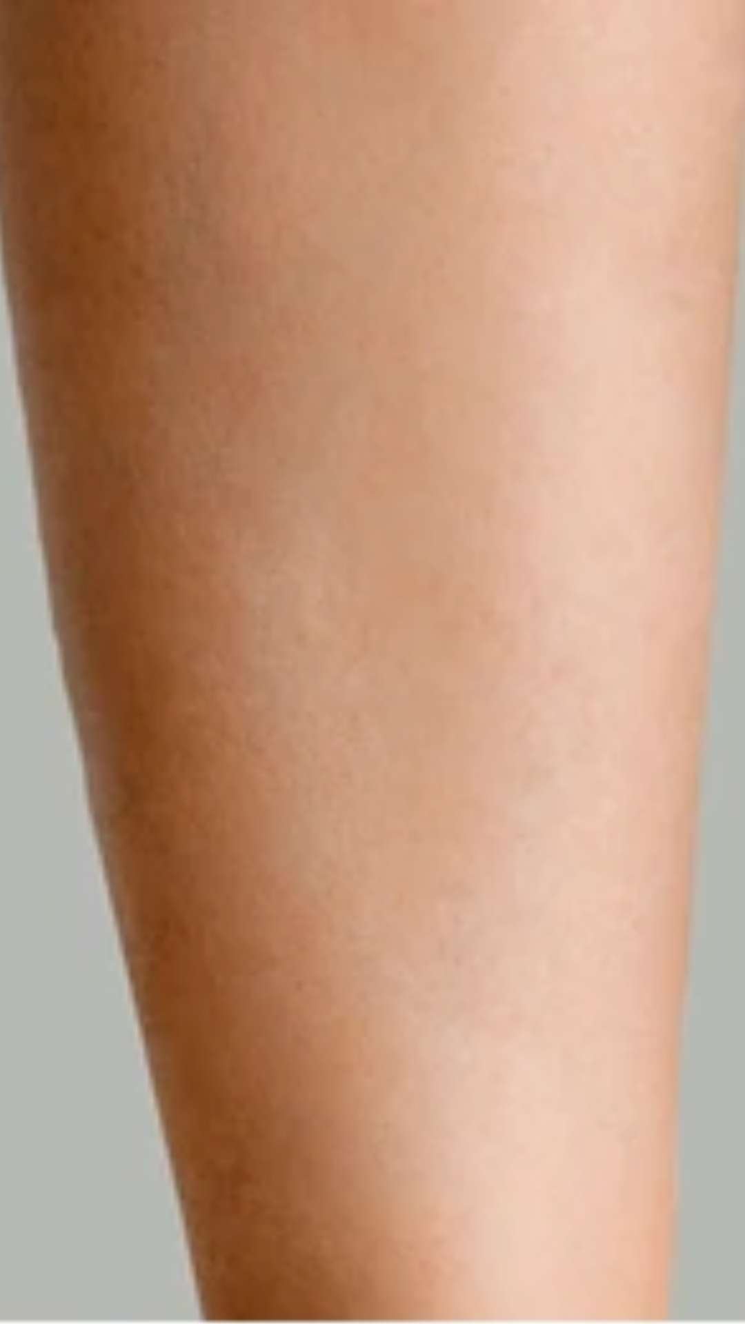 Avant épilation laser bras poilu