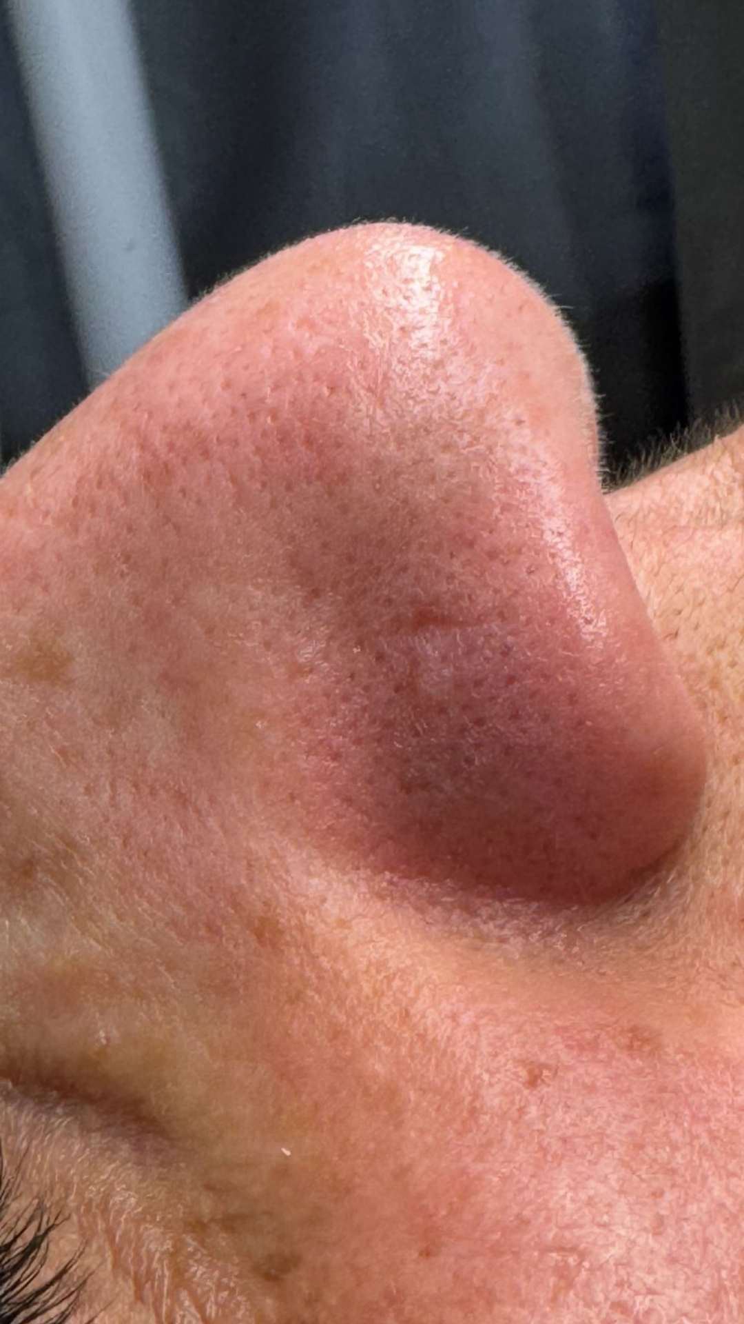 Avant soin nez points noirs