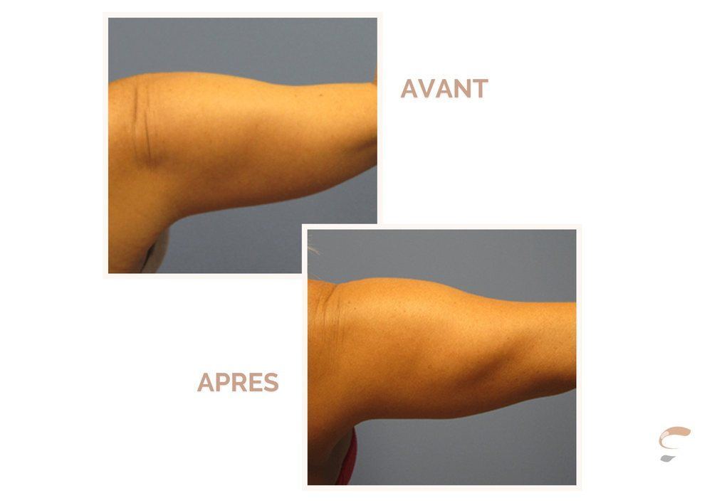 Avant après Supra Sculpt bras femme