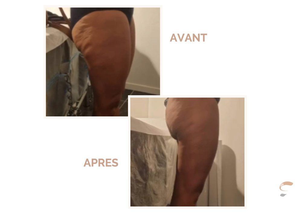 Avant après Supra Sculpt cellulite cuisses