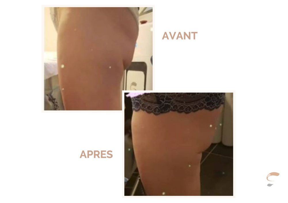 Avant après Supra Sculpt cuisse hanche