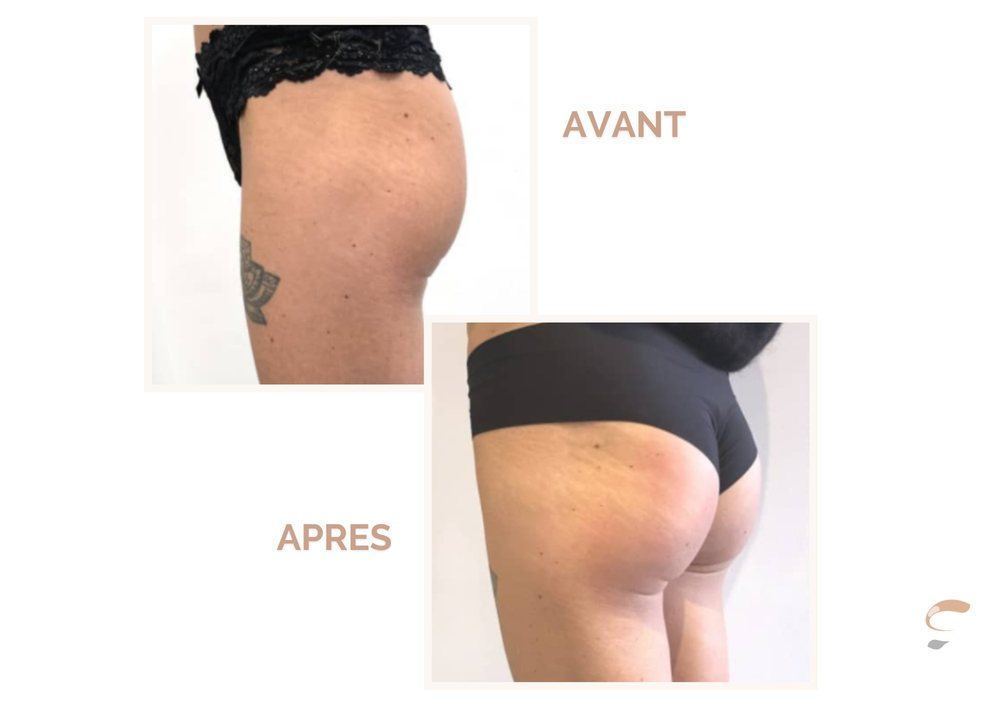 Avant après Supra Sculpt cuisses fesses