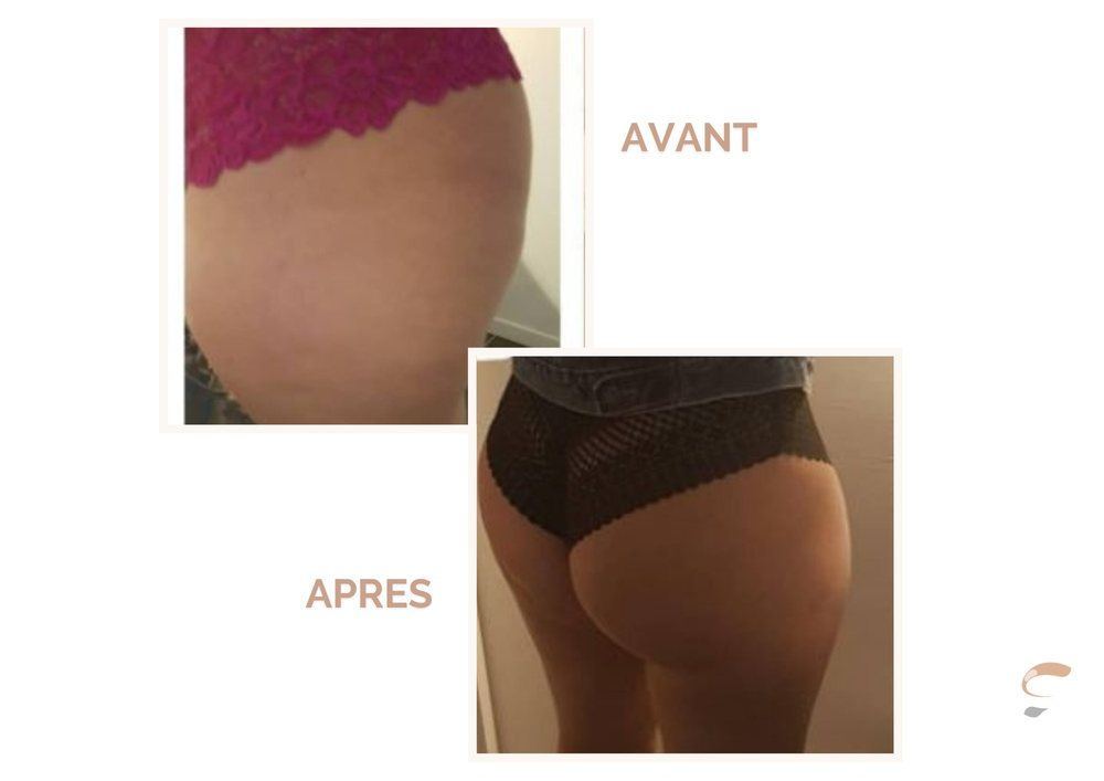 Avant après Supra Sculpt fesses cellulite