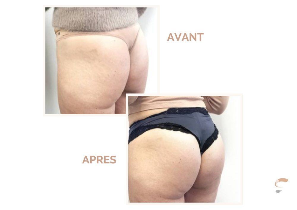 Avant après Supra Sculpt fesses