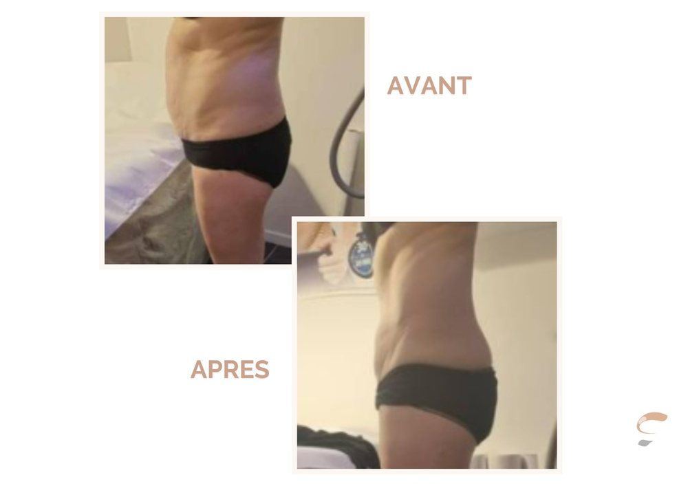 Avant après Supra Sculpt flancs silhouette