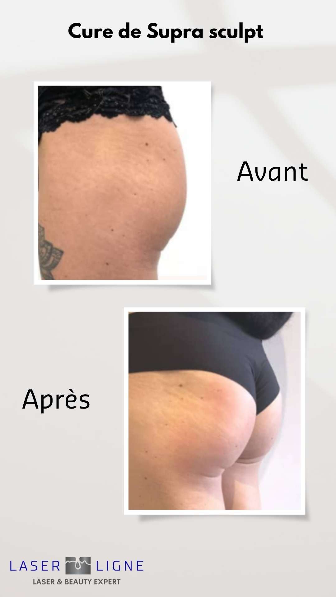 Avant après Supra Sculpt cuisses fesses Laser Ligne Groslay