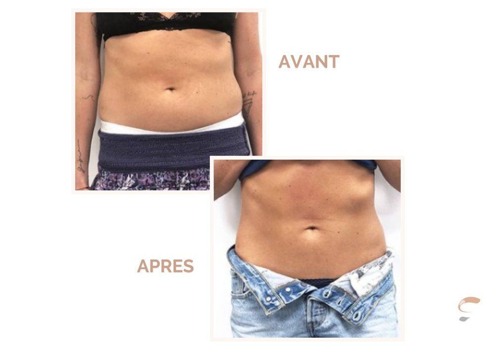 Avant après Supra Sculpt ventre femme