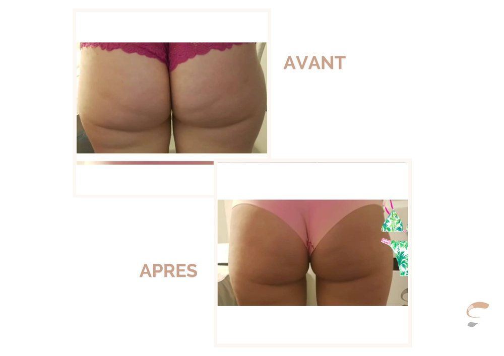 Avant après Supra Sculpt ventre femme 2