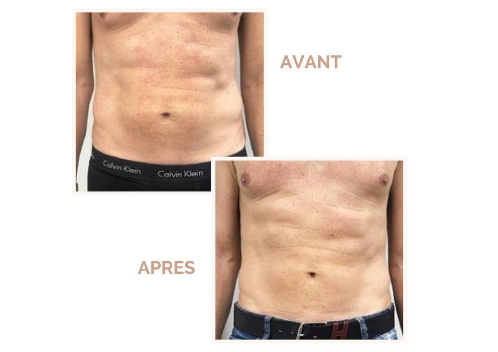 Avant après Supra Sculpt ventre homme