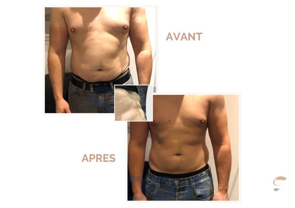 Avant après Supra Sculpt ventre homme 2