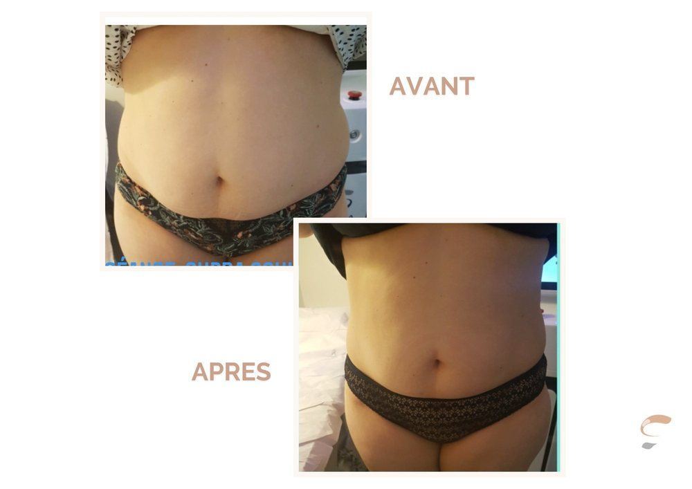 Avant après Supra Sculpt torse homme