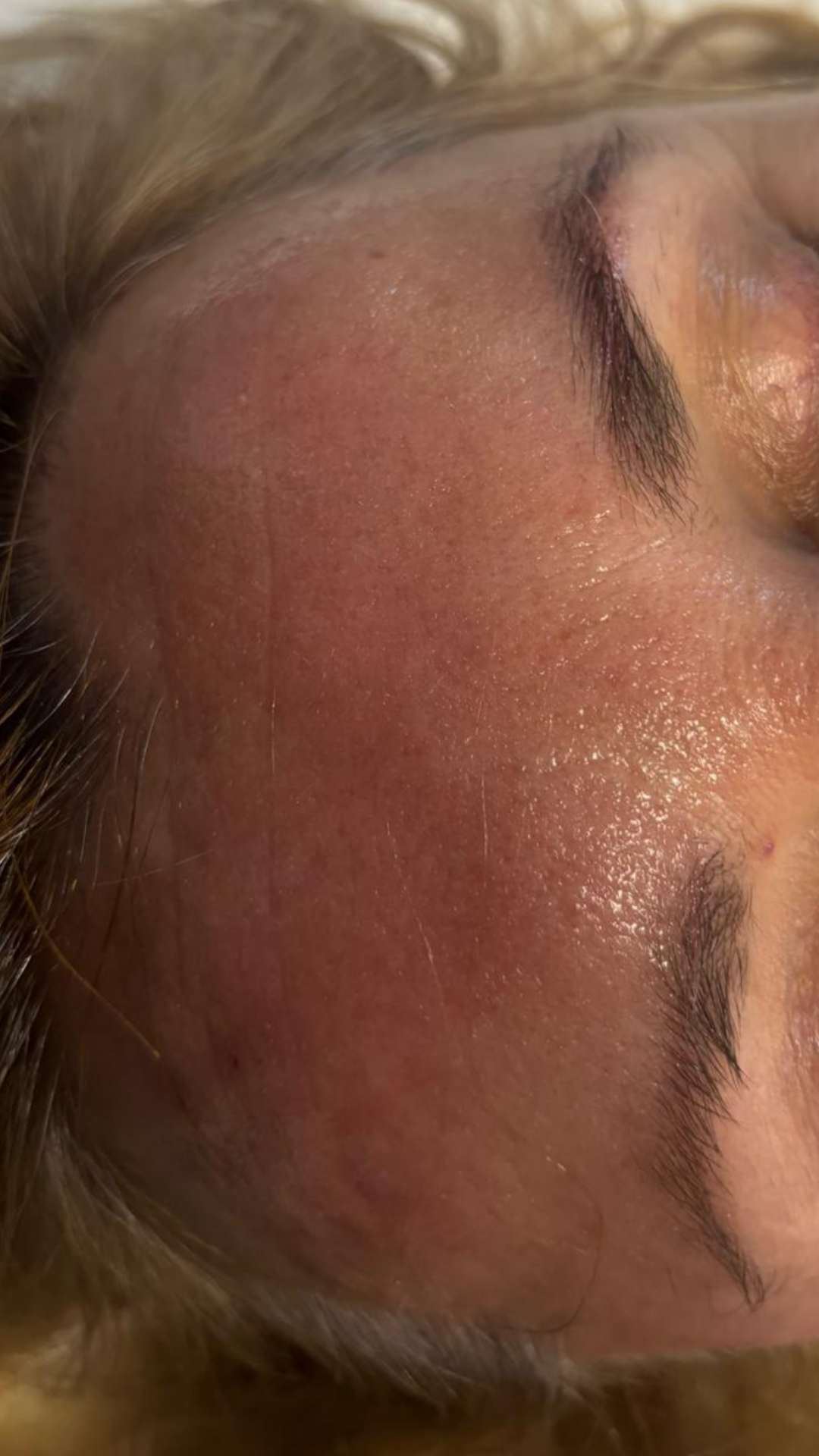 Avant radiofréquence rides