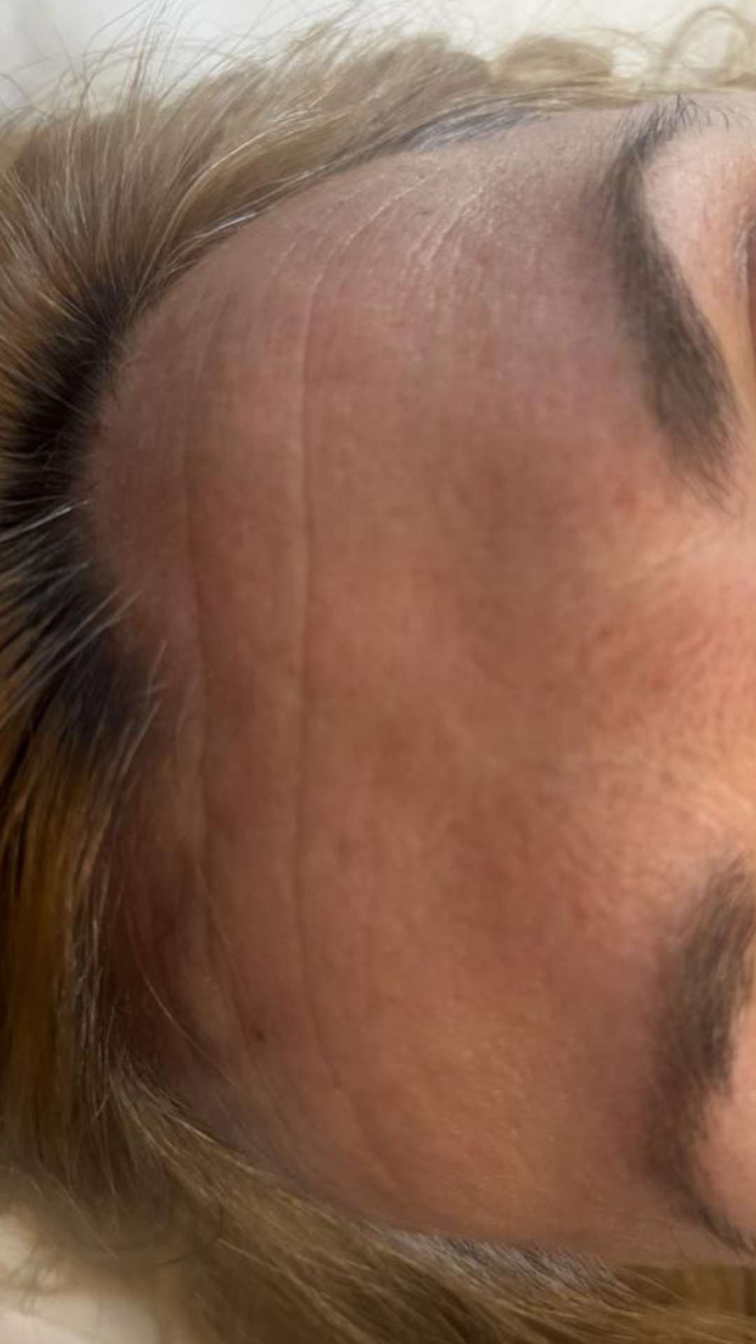 Après radiofréquence