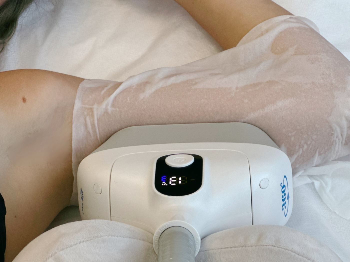 Séance cryolipolyse cuisse Laser Ligne