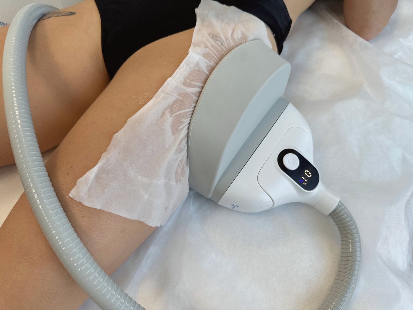 Cryolipolyse bras Laser Ligne 95